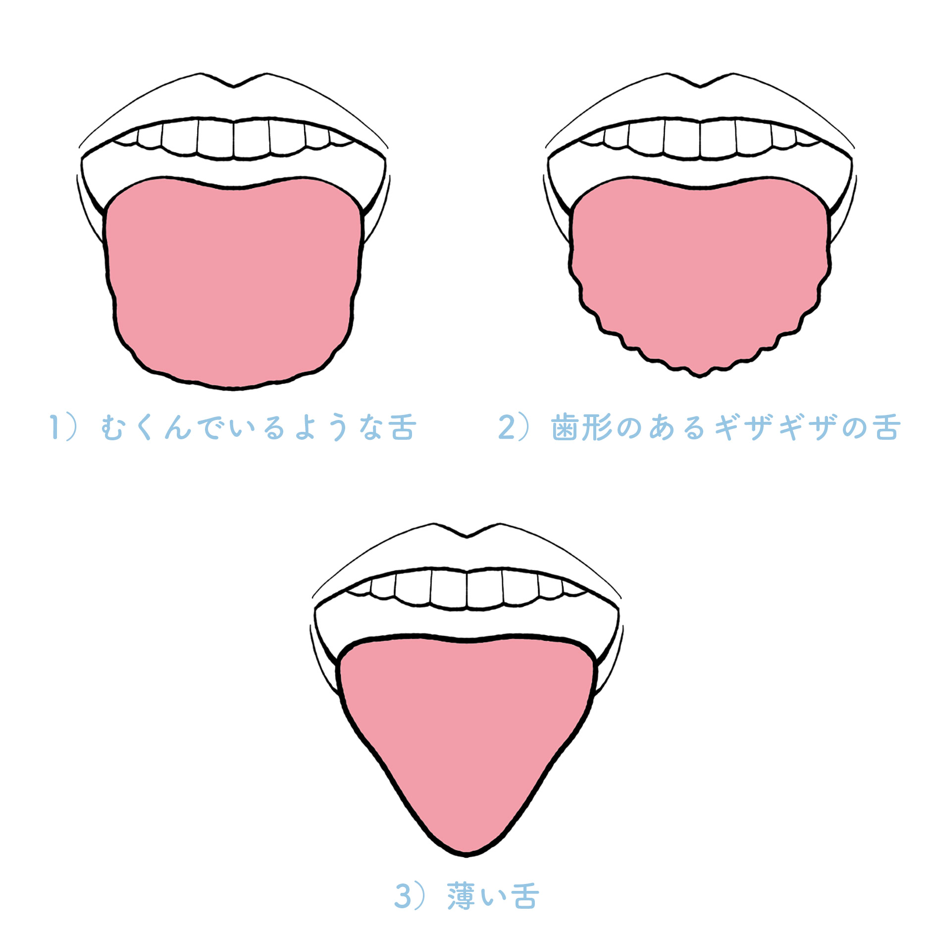 舌 の むくみ 歯形